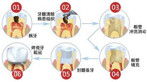 广州广大口腔牙齿根管治疗步骤讲解