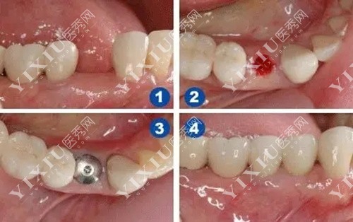 衡水口腔牙齿种植步骤
