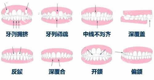 需要做牙齿矫正的几种牙齿情况实拍