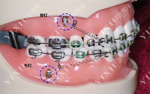 牙齿矫正骨钉示意模型