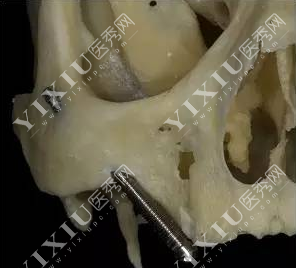 穿颧种植牙固定位置示意图