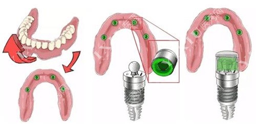 半固定种植牙示意图
