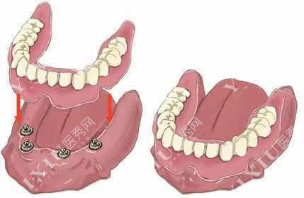 半固定种植牙示意图