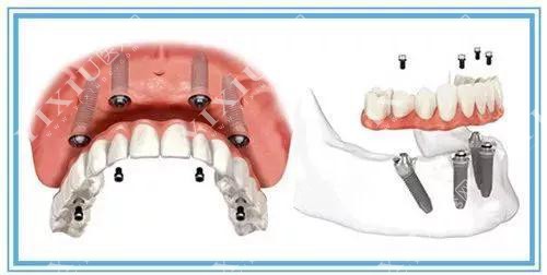 全口种植牙示意图