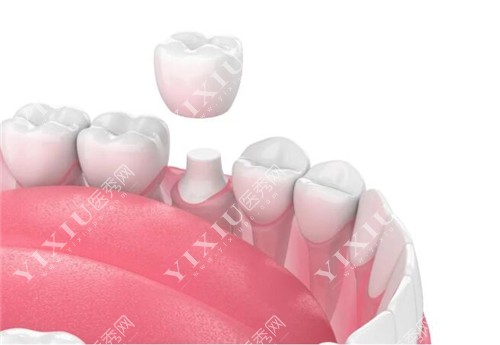 固定义齿全瓷牙冠示意图