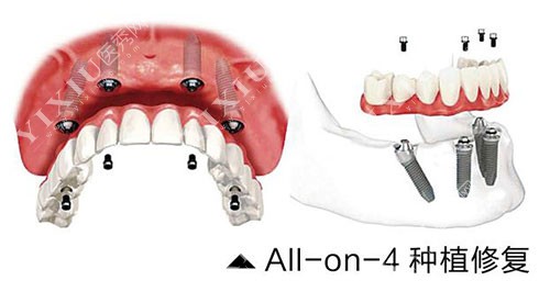 all-on-4种植牙修复技术示意图