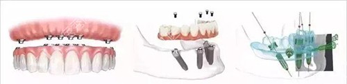 全口种植牙示意图