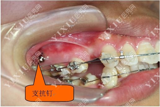 牙齿矫正支抗钉示意图