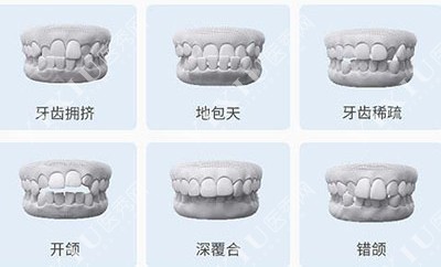 牙齿矫正错颌畸形症状