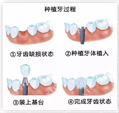 种植牙过程