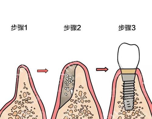 种植牙植骨粉步骤