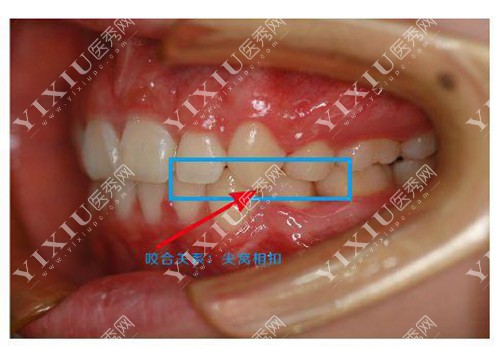 牙齿矫正咬合示意图