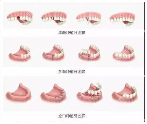 不同颗数种植牙图解