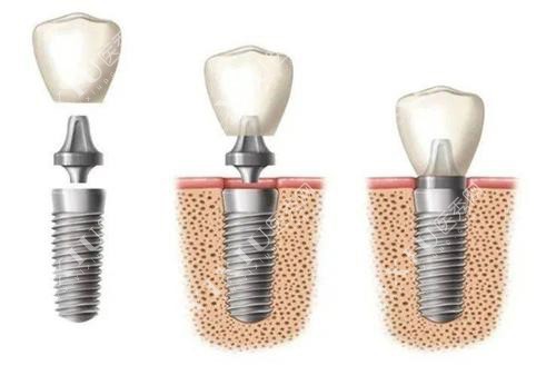 种植牙步骤