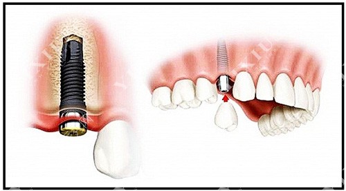 种植牙示意图