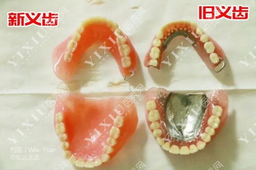 吸附性义齿和普通义齿对比