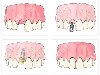 种植牙步骤
