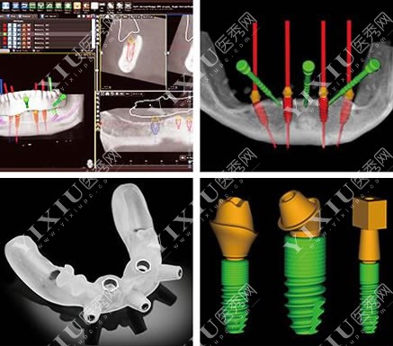 数字化种植牙原理分析