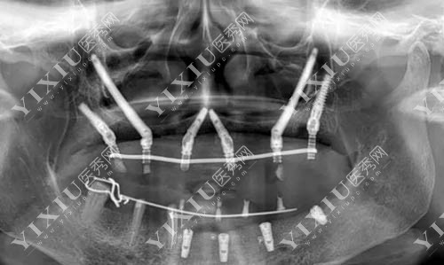 全口种植牙CT照片展示