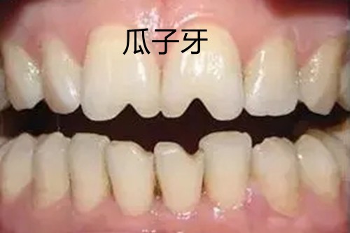 牙齿瓷贴面的优缺点介绍，哈尔滨牙齿贴面哪家牙所好？