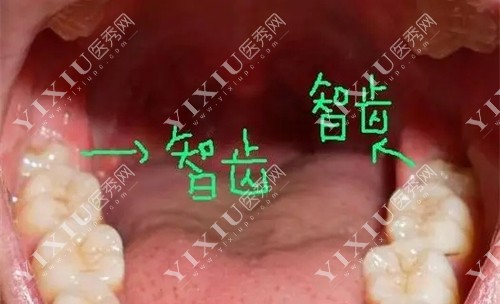 智齿冠周炎怎么办？冠周冲洗真的能缓解吗？-医秀网