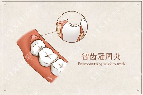 智齿冠周炎怎么办？冠周冲洗真的能缓解吗？-医秀网