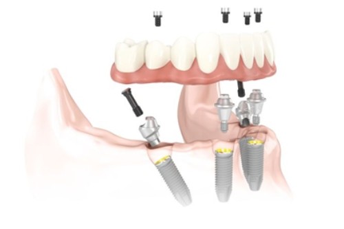 扬州贝恩口腔种植牙优势分享！植牙技术与收费统统告诉大家(图6)