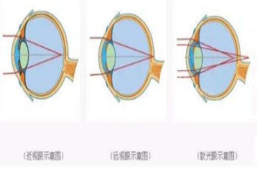 远视、近视、散光示意图