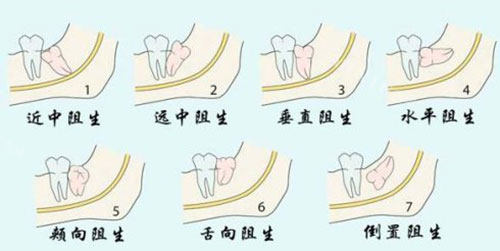 牙齿阻生智齿各种形态示意图
