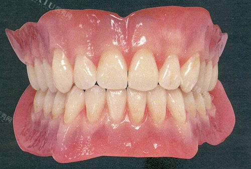 纯钛假牙托对人体有害吗？详细分析纯钛假牙的优点缺点！(图2)