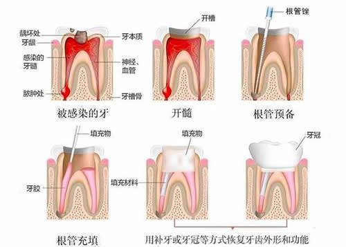 牙齿根管治疗示意图