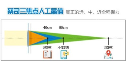 三焦点人工晶体后视力变化