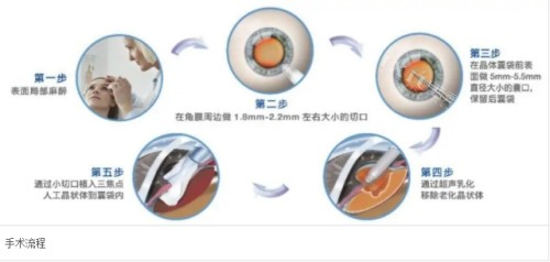 三焦点人工晶体手术步骤图