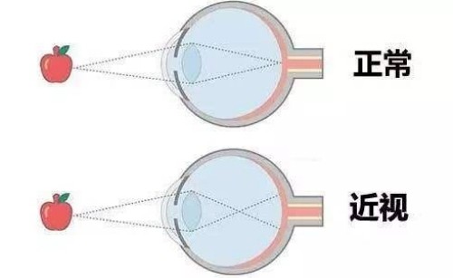 正常视力与近视眼的区别