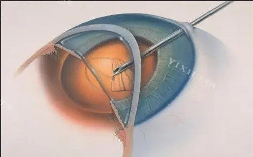 眼部治疗过程卡通图