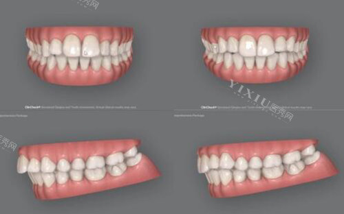 细品！我做隐适美正畸全过程经历揭秘！(图2)