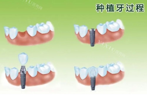 大连种植牙多少钱一颗？登腾／诺贝尔／创英等植体价格公布！(图2)