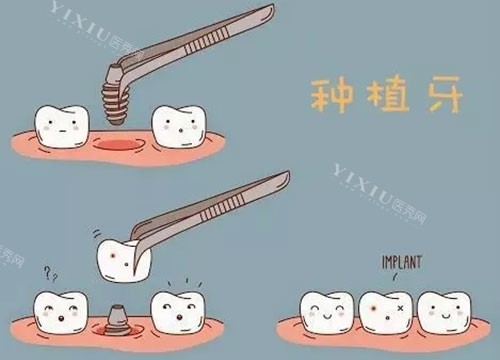 北京牙科医院种牙价格表，含单颗／半口／全口种植牙收费标准(图2)