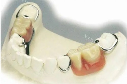 镶牙模具图