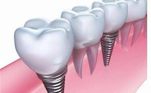 不同种植牙价格一览表，如何选择更适合的植体？(图2)