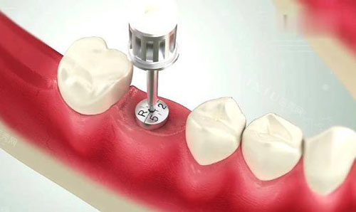 想知道种牙会很痛吗，做种植牙有什么好处和坏处？(图3)