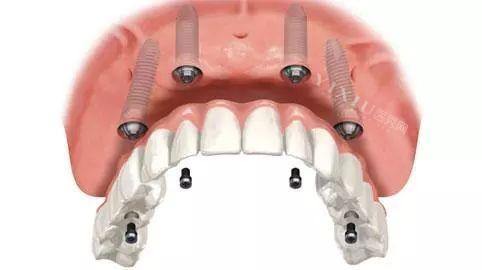 中老年人做全口种牙都要穿颧穿翼？骨量不足的种牙方案推荐(图2)
