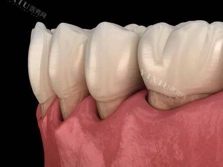 被洗牙费用背刺？探一探目前常见牙齿洁治方式及大概价位~(图2)