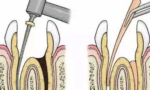 根管治疗示意图