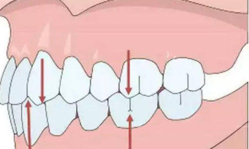 牙齿咬合标准示意图