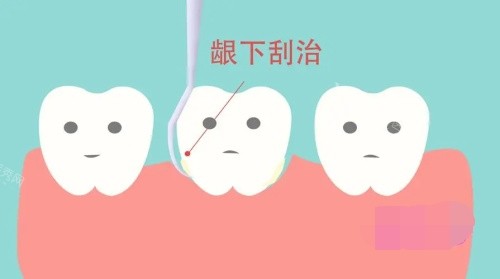 龈下刮治的示意图