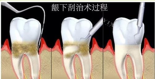 龈下刮治的过程
