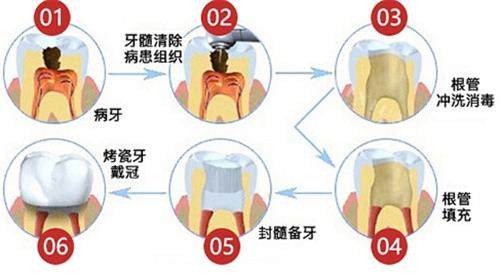 牙烂到什么程度要根管治疗？根管治疗后该怎么办？-医秀网