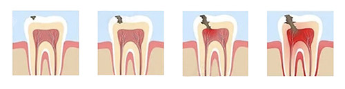 牙齿龋变的过程