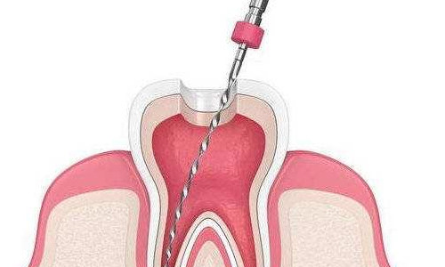 根管治疗示意图